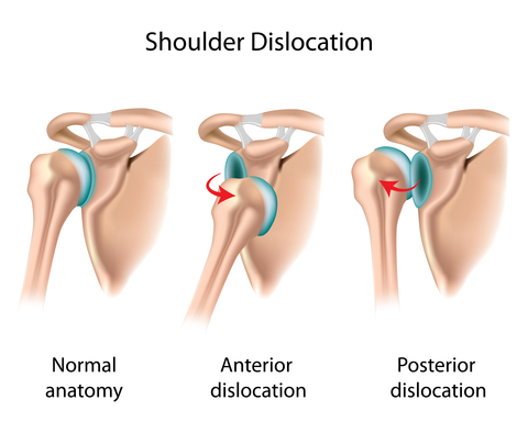 This image has an empty alt attribute; its file name is Shoulder-Dislocation_1.jpg