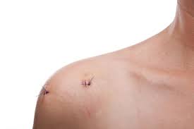 This image has an empty alt attribute; its file name is shoulder-arthroscopy.jpg