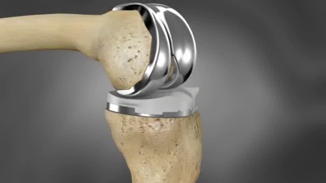 This image has an empty alt attribute; its file name is ConforMIS-iTotal-Knee-Implant.jpg