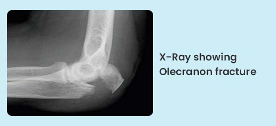 X-Ray showing Olecranon fracture