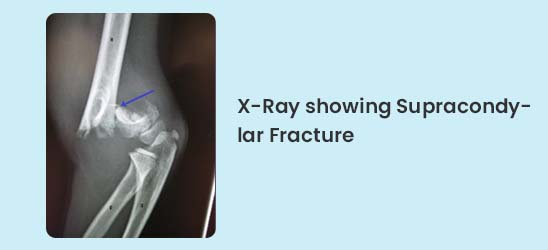 X-Ray showing Supracondylar Fracture