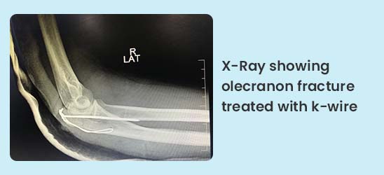 X-Ray showing olecranon fracture treated with k-wire