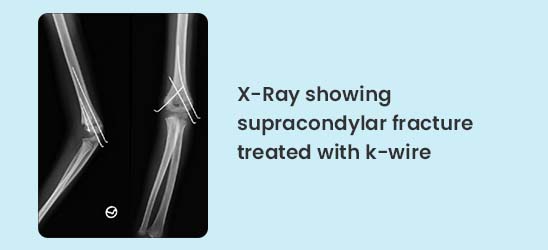 X-Ray showing supracondylar fracture treated with k-wire