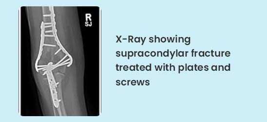 X-Ray showing supracondylar fracture treated with plates and screws