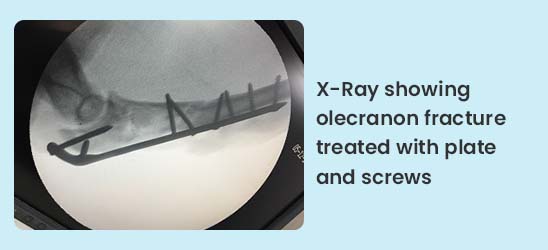 XRay showing olecranon fracture treated with plate and screws
