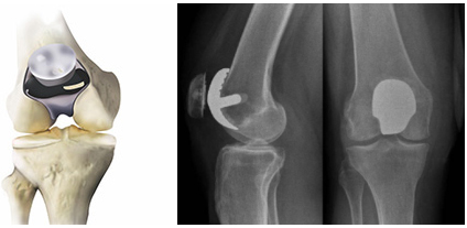 patellofemoral-joint1